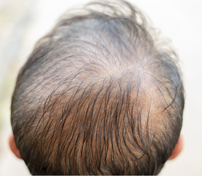 Ascorbic Acid for Hair Growth & Scalp Health
